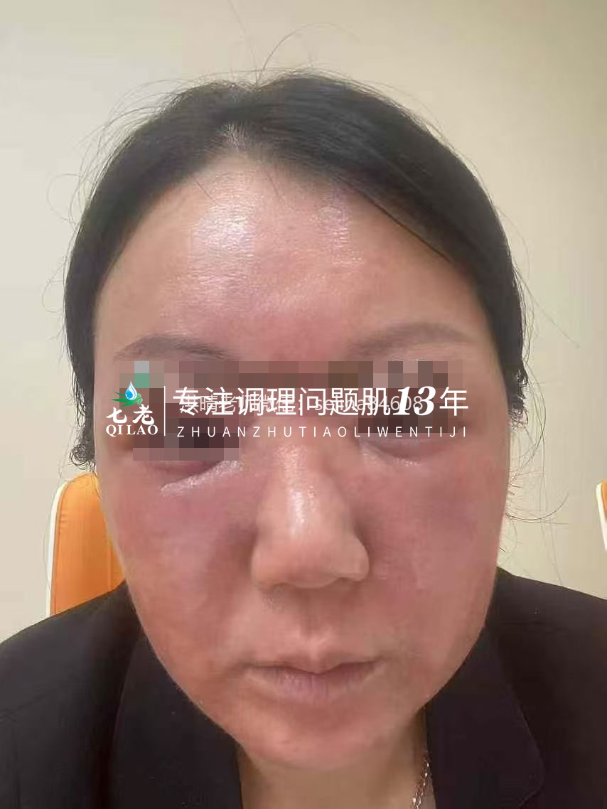 七老激素脸修复案例