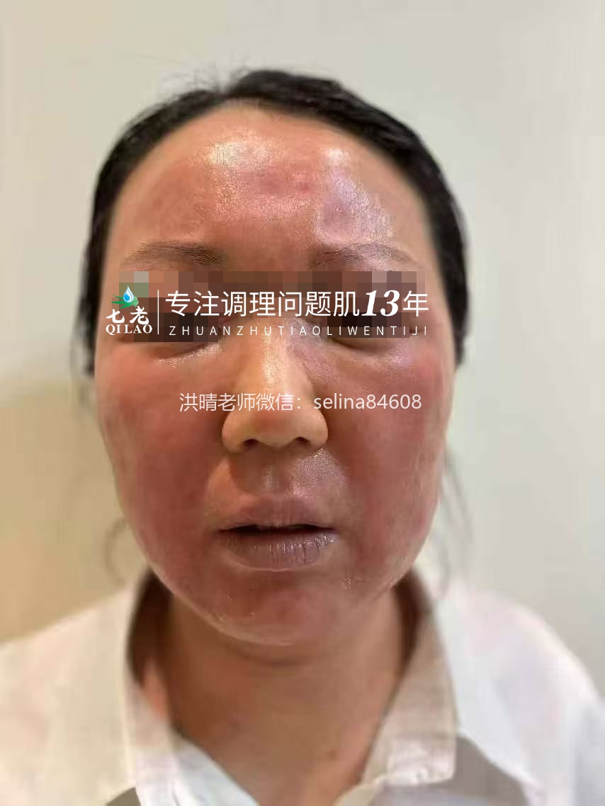 七老激素脸修复案例