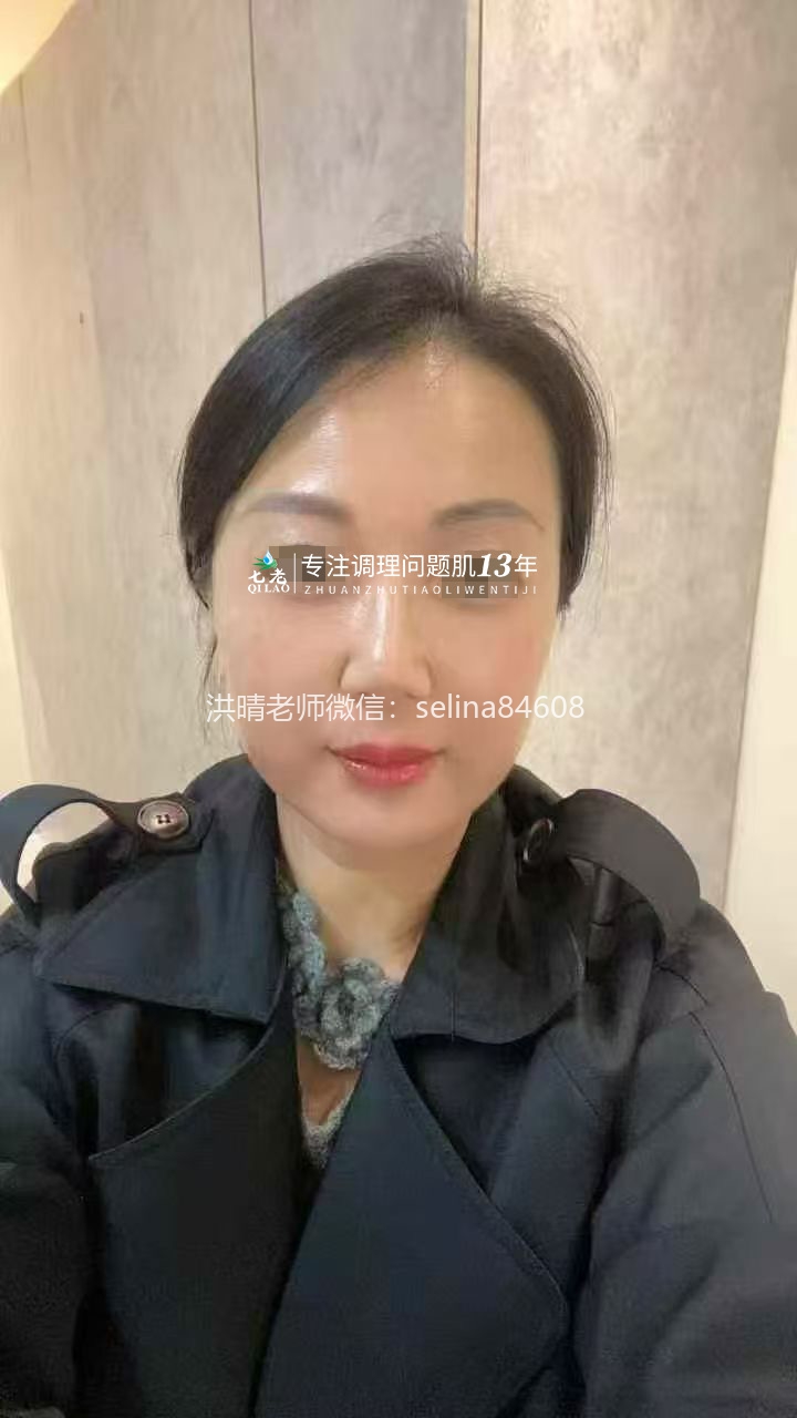 七老激素脸修复案例