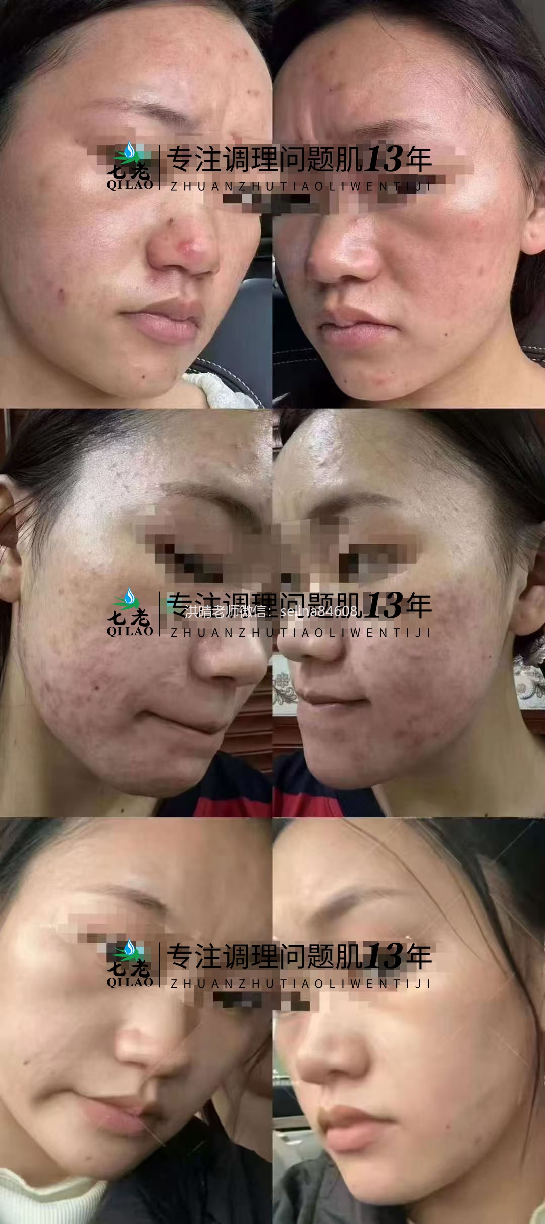 七老激素痘修护案例