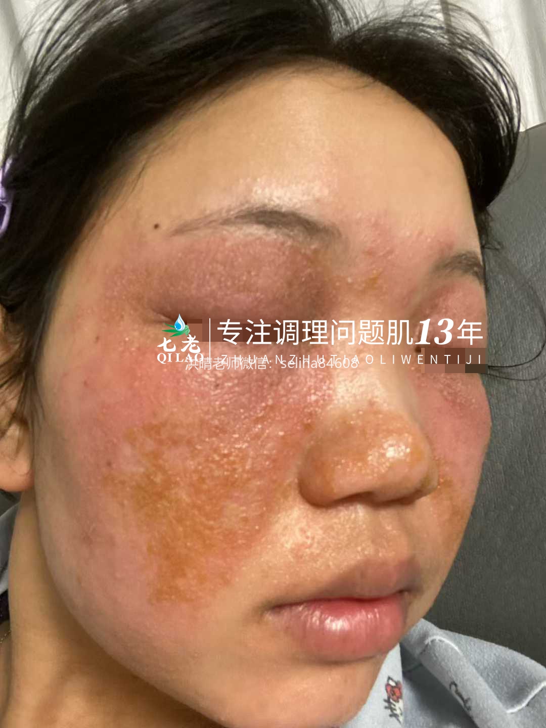 七老严重激素脸红肿烫痒疹子流黄水修护案例