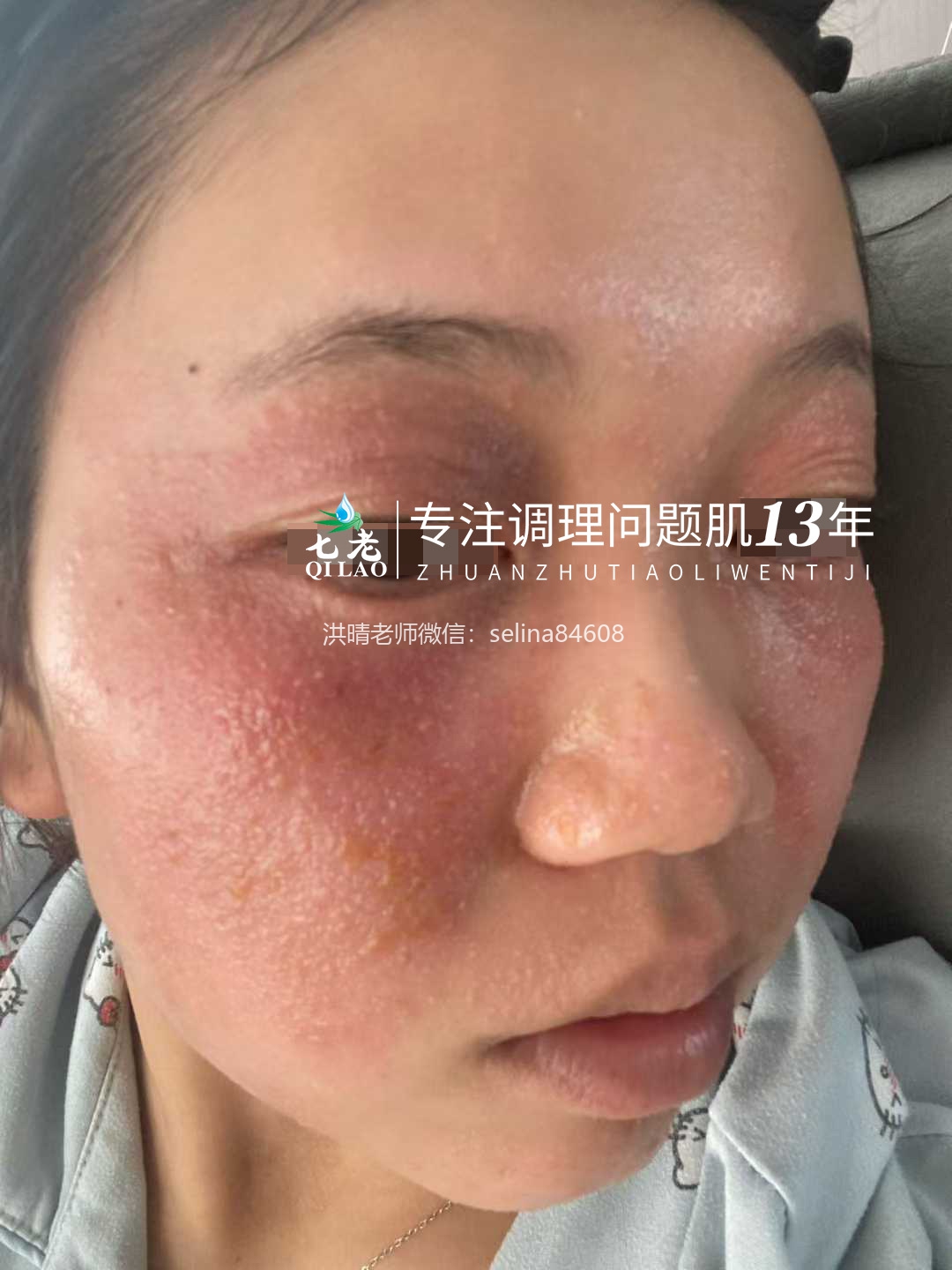 七老严重激素脸红肿烫痒疹子流黄水修护案例