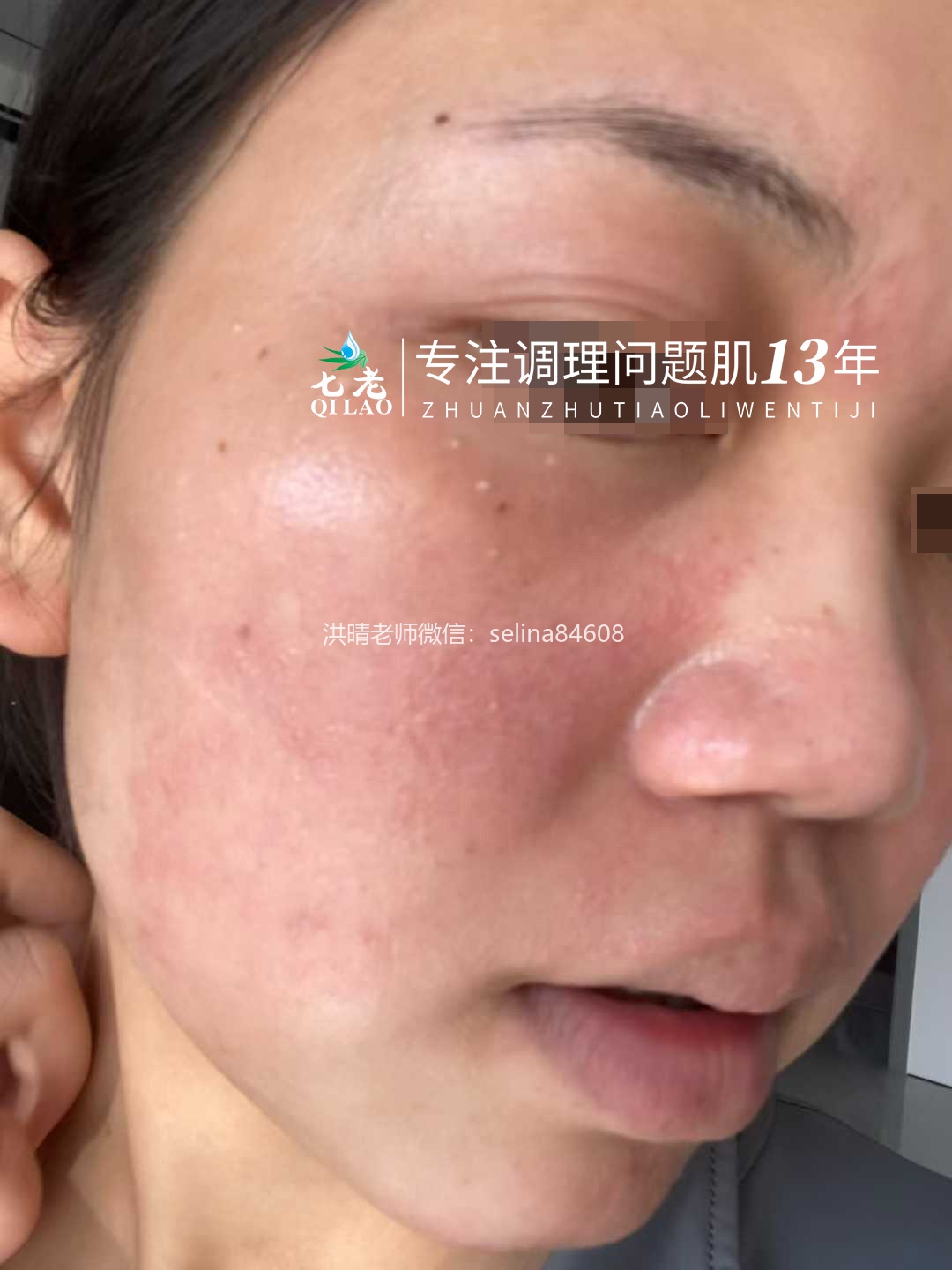 七老严重激素脸红肿烫痒疹子流黄水修护案例