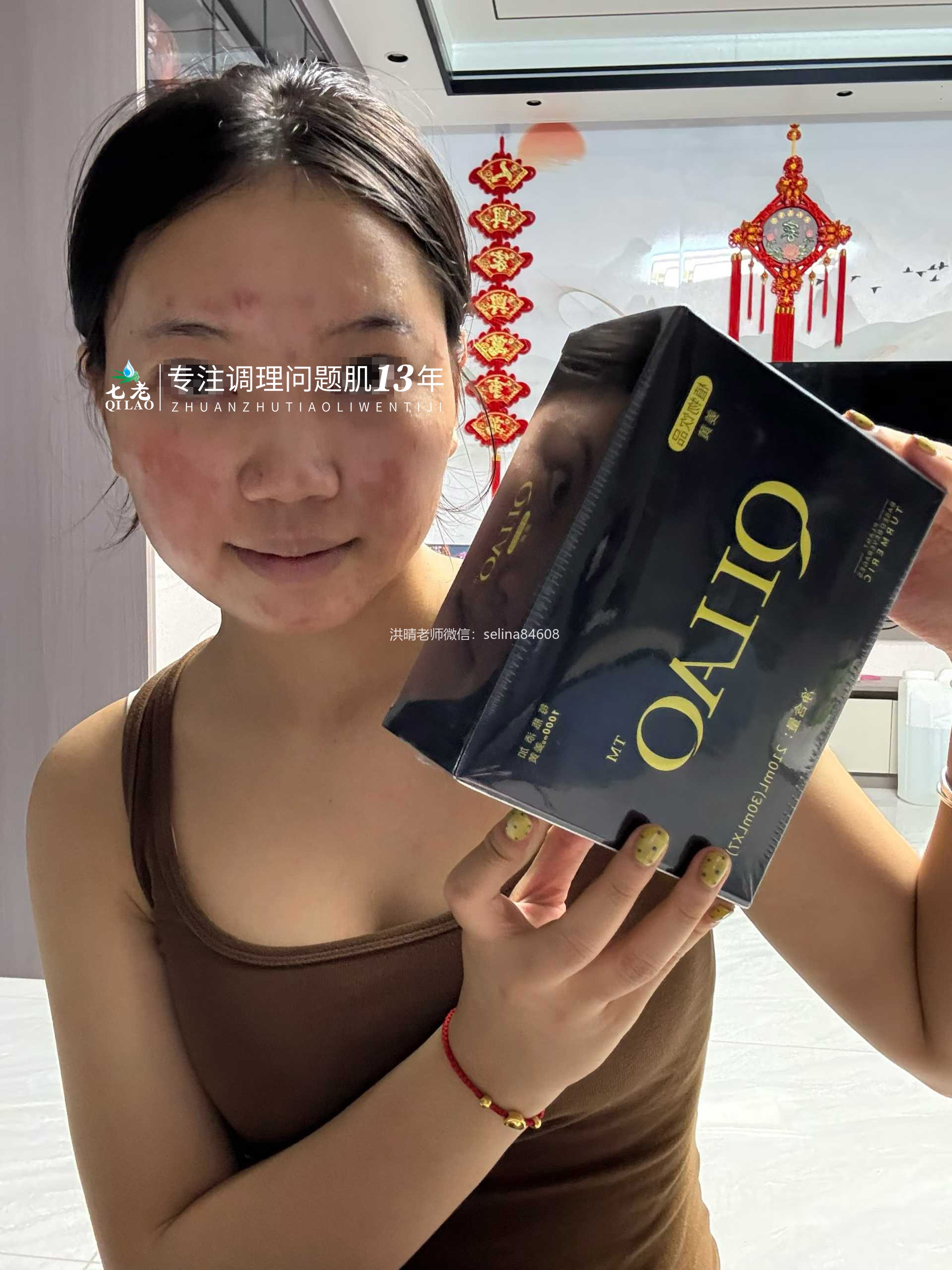 七老严重激素脸红肿烫痒疹子流黄水修护案例