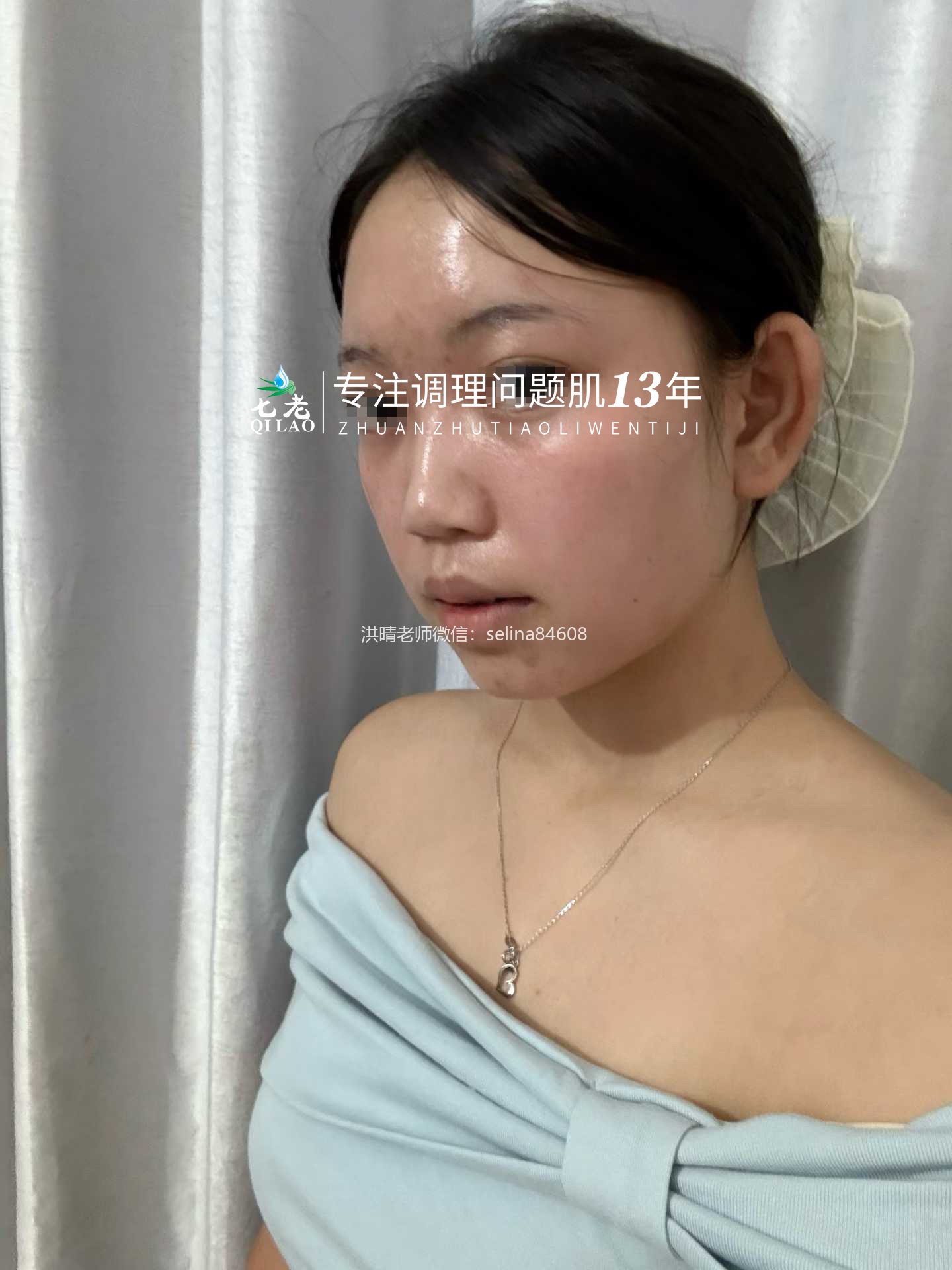 七老严重激素脸红肿烫痒疹子流黄水修护案例