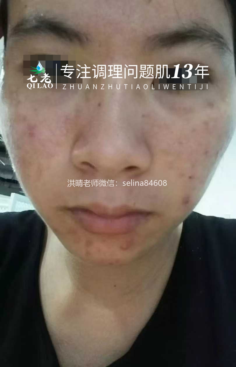 七老敏感肌修护案例