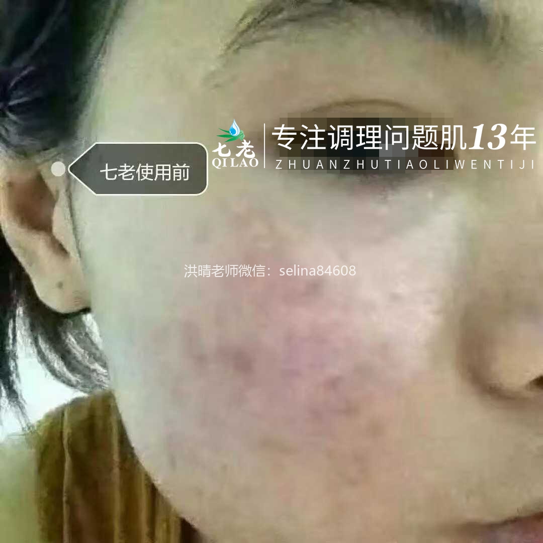 七老敏感肌修护案例