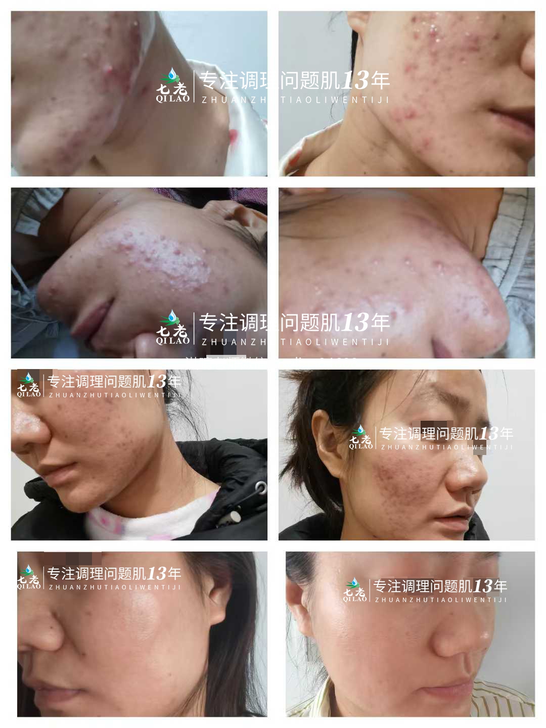 七老激素痘修护案例