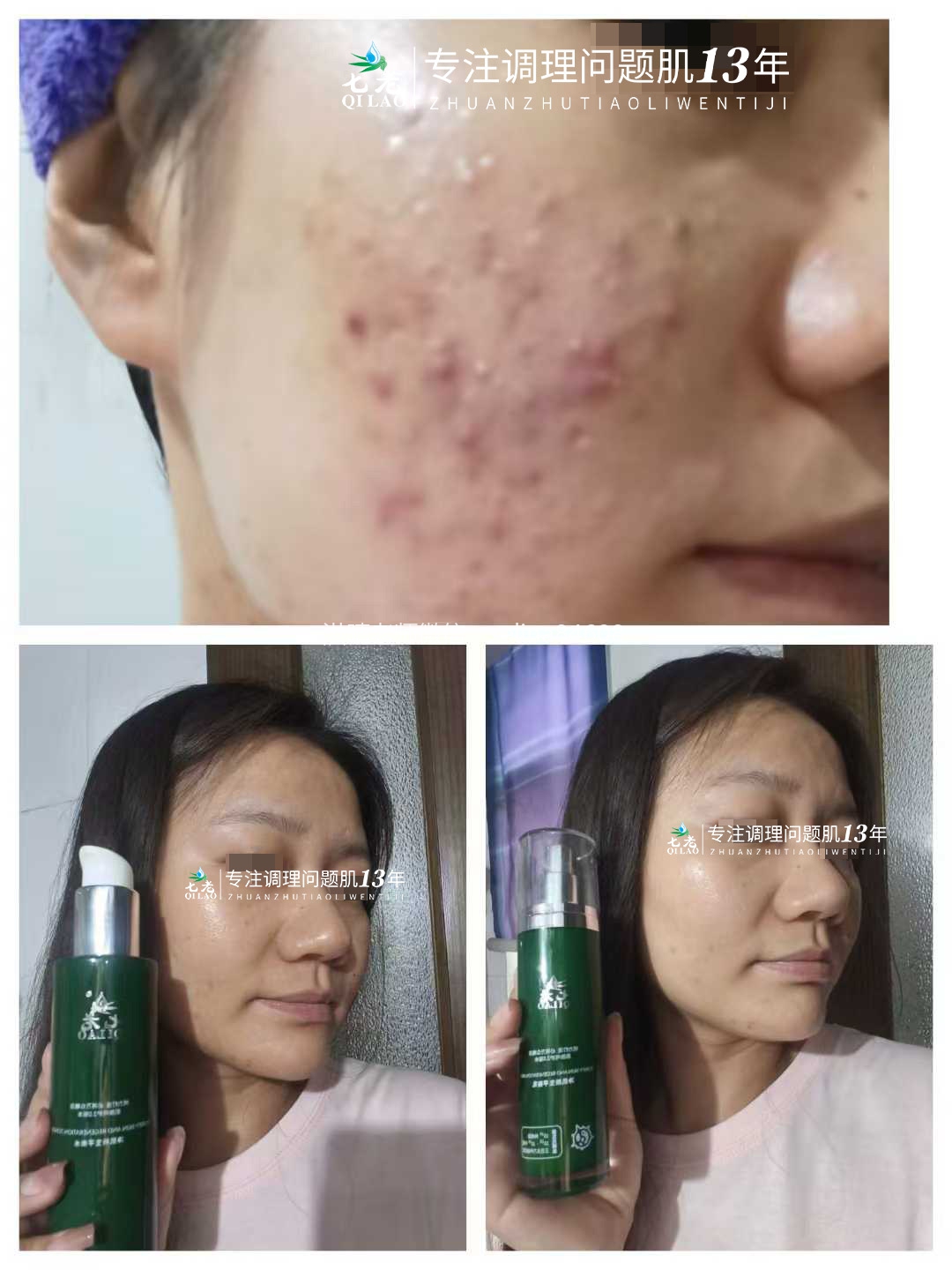 七老激素痘修护案例