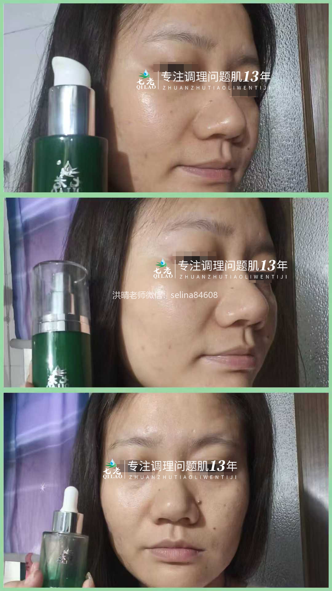 七老激素痘修护案例