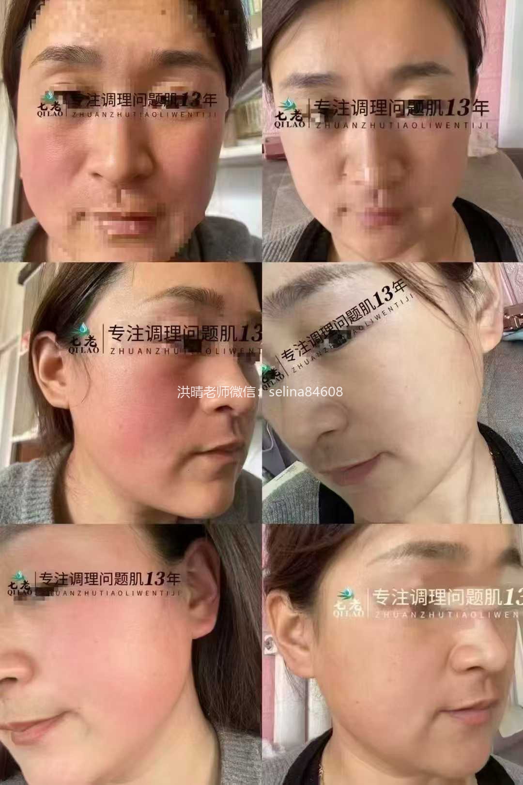 七老红烫肌大红脸修护案例