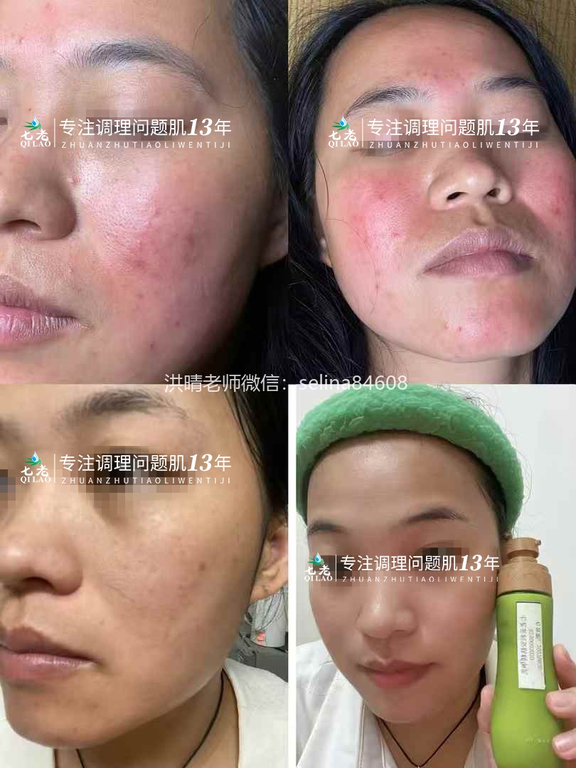 七老激素脸修护案例