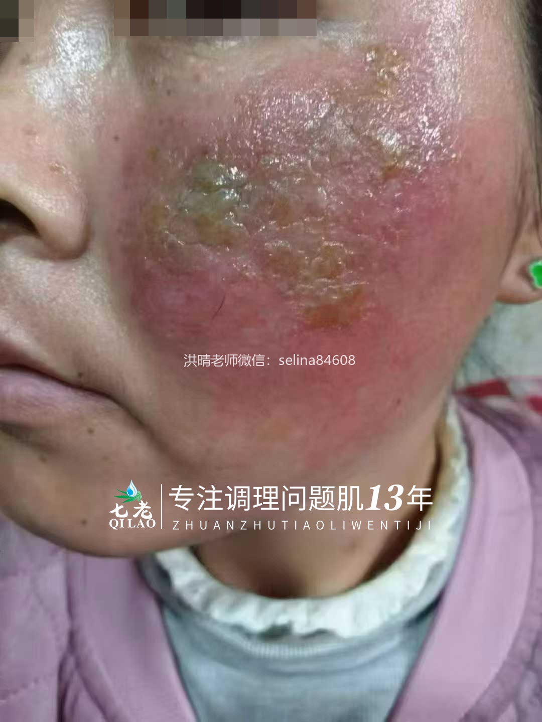 七老激素脸红肿痒渗液流黄水修护案例