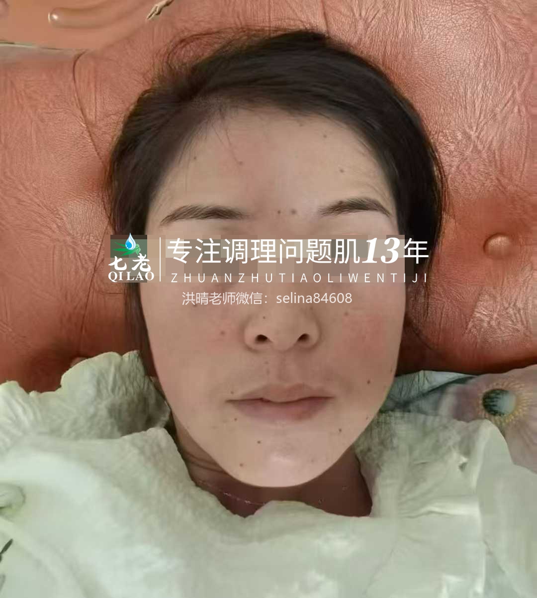 七老激素脸红肿痒渗液流黄水修护案例