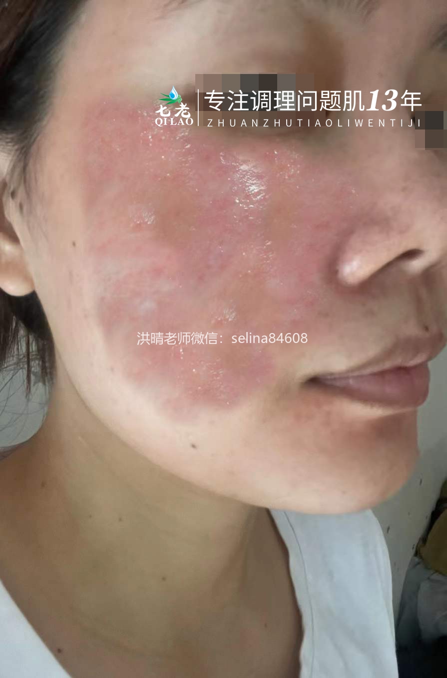 七老严重激素脸修护案例