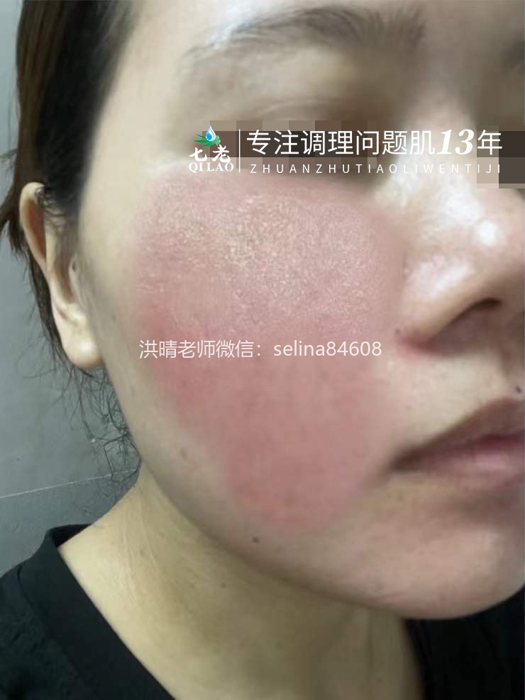 七老严重激素脸修护案例