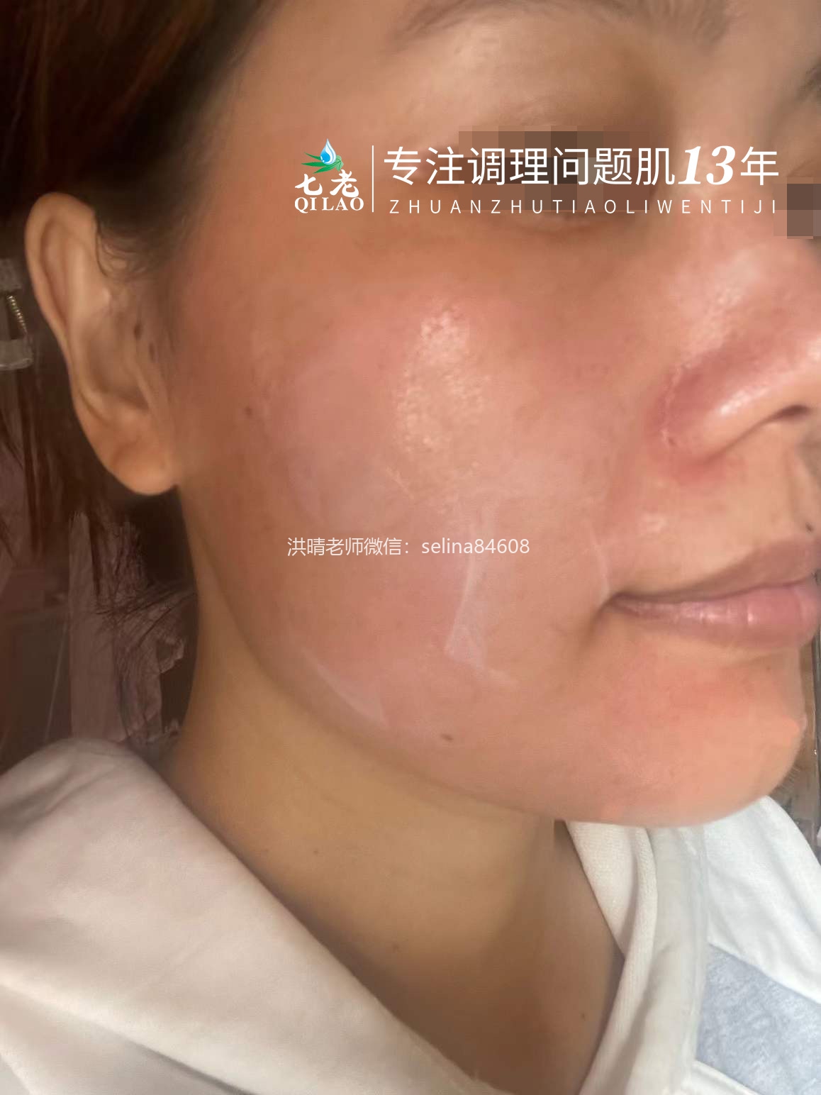 七老严重激素脸修护案例