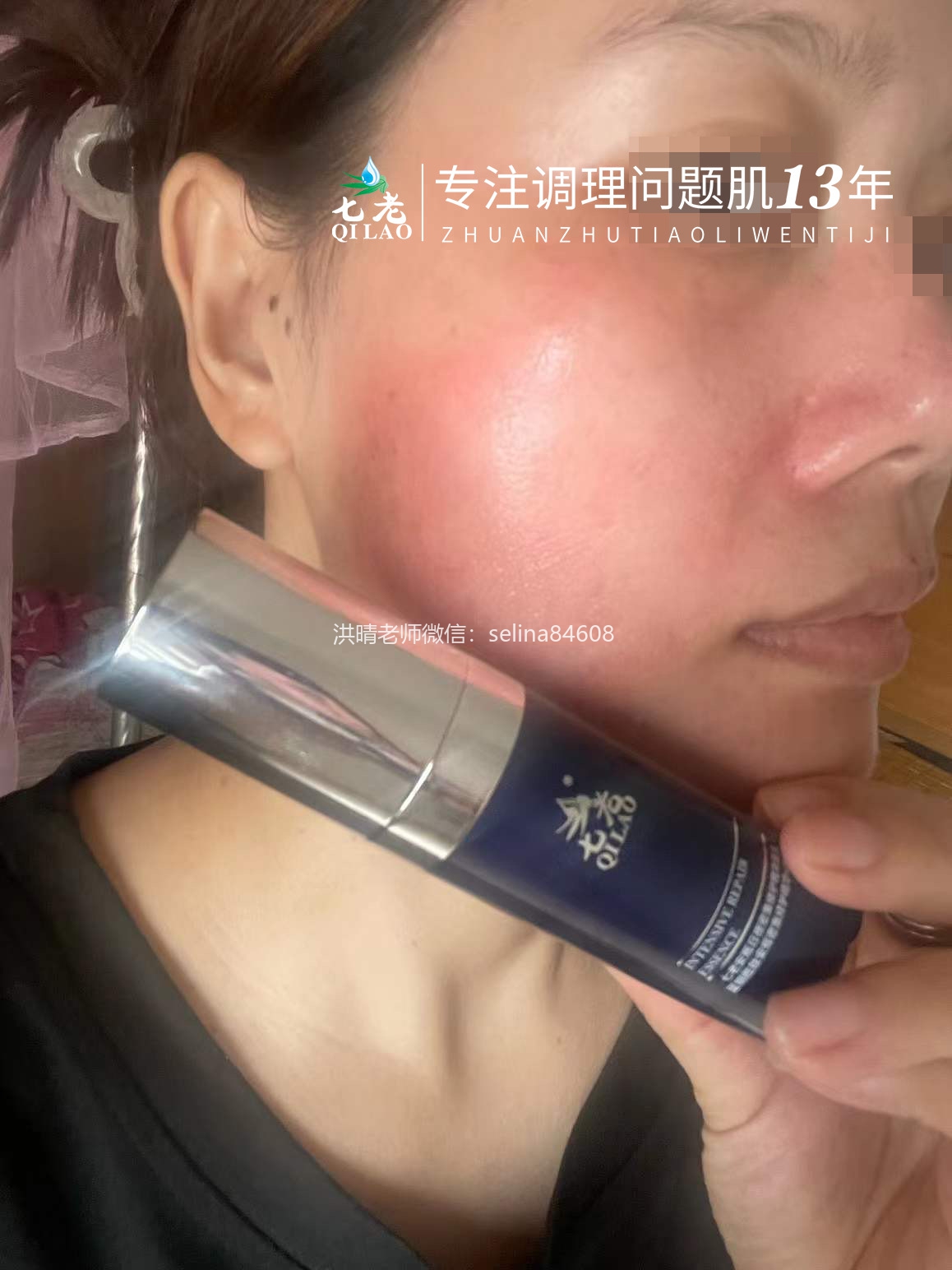 七老严重激素脸修护案例