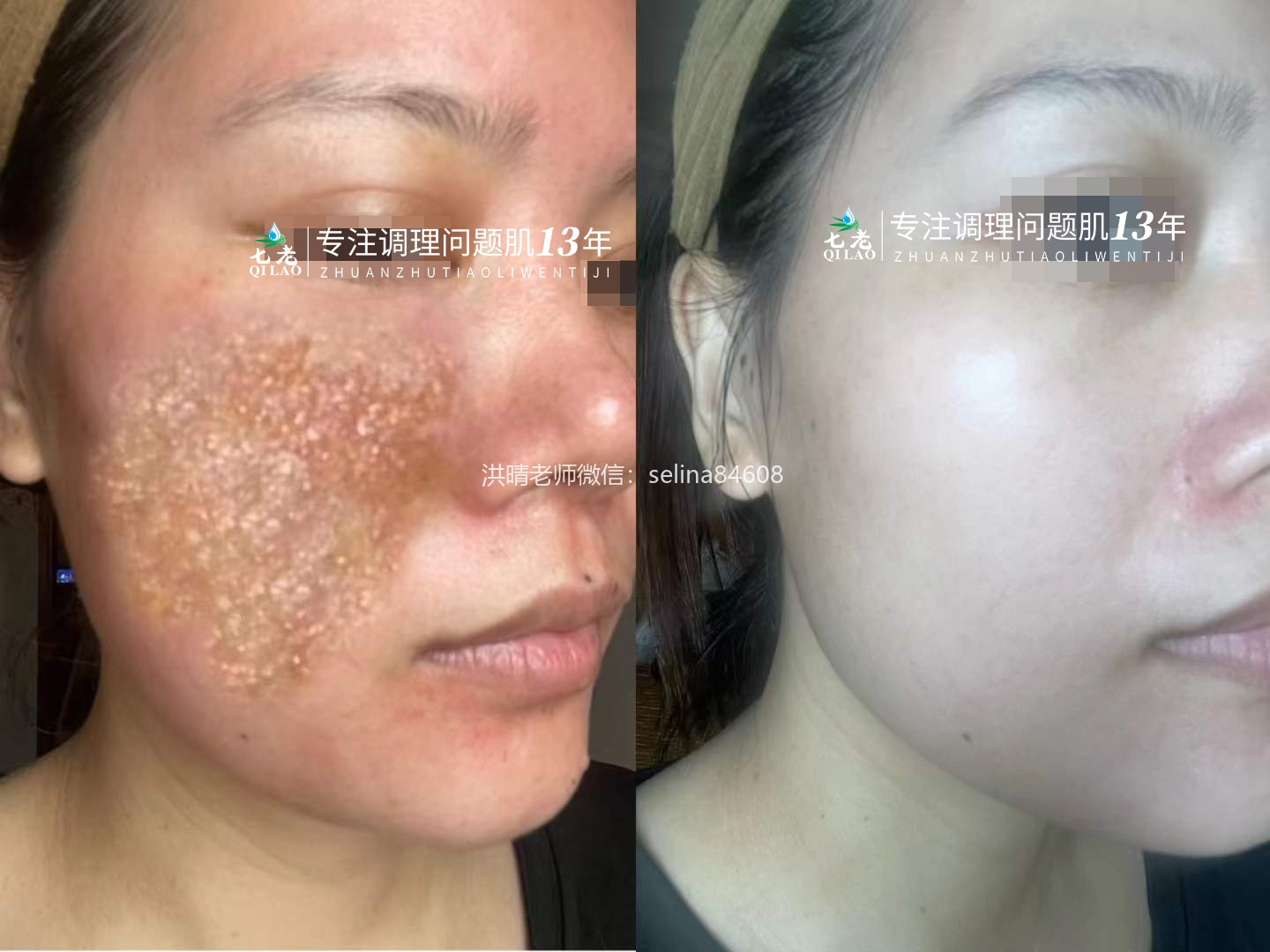 七老严重激素脸修护案例