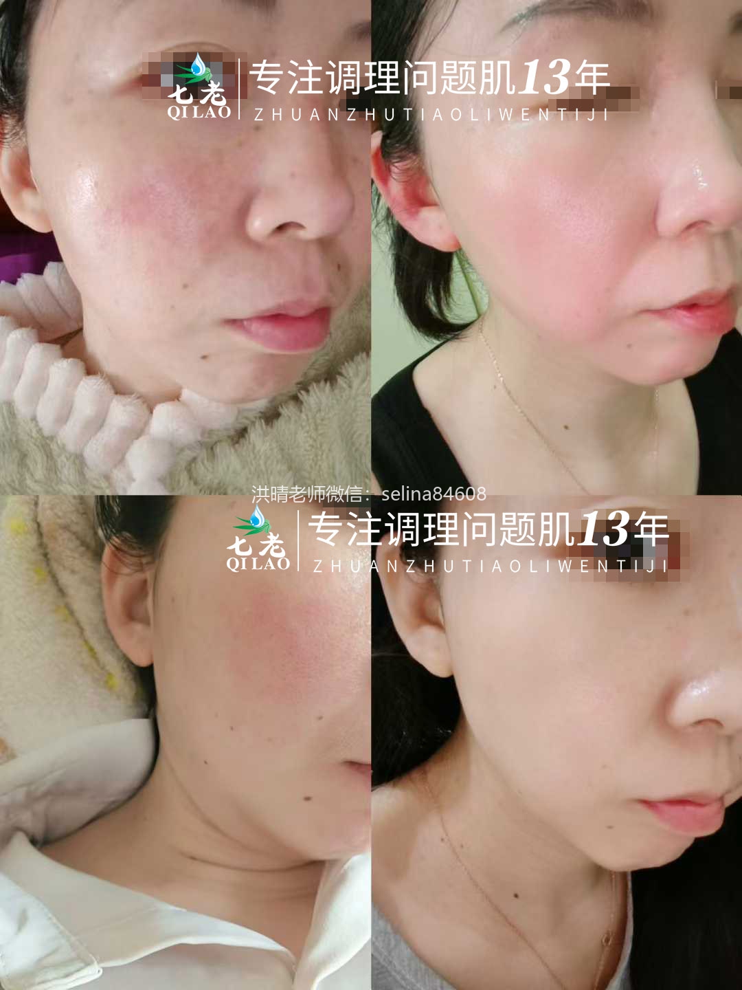 七老大红脸修护案例