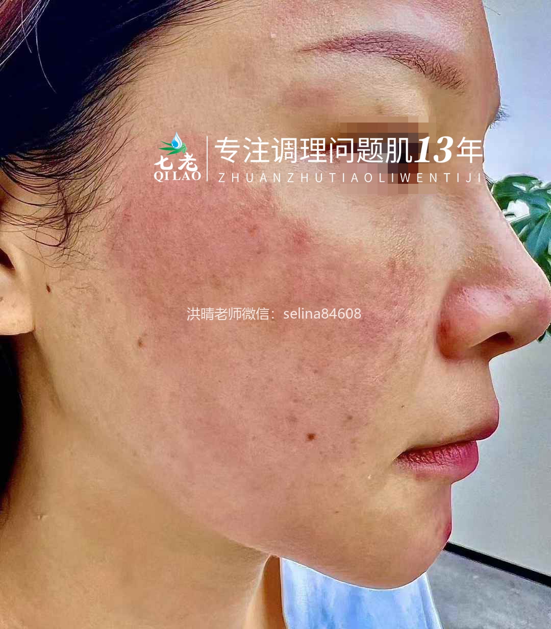 七老剥脱祛斑过敏粉刺痘痘修护案例
