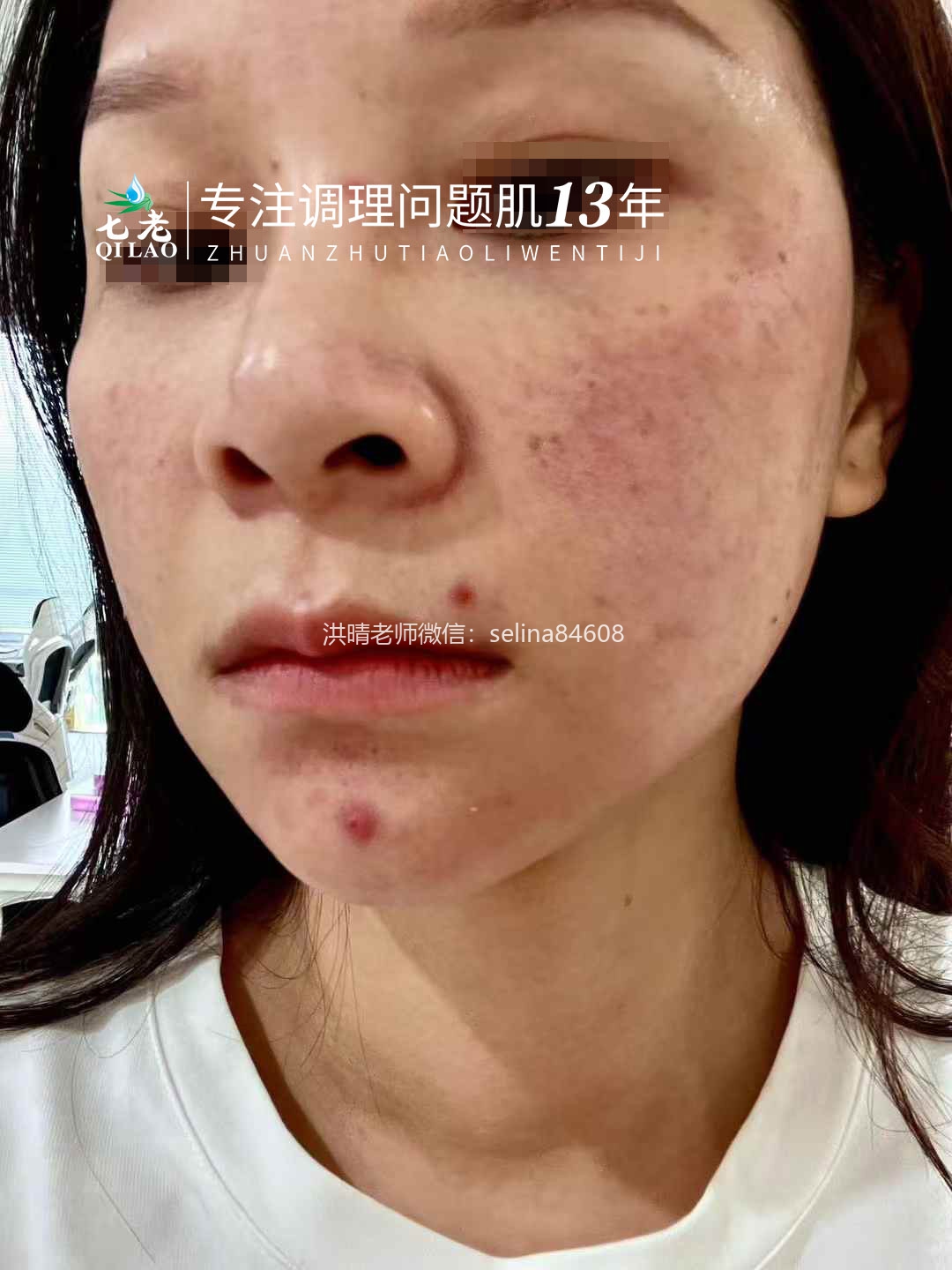 七老剥脱祛斑过敏粉刺痘痘修护案例