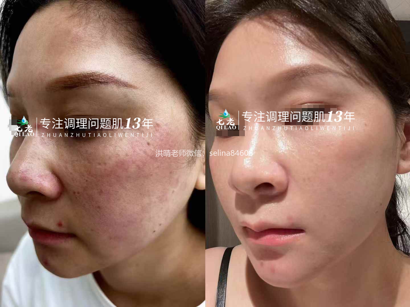 七老剥脱祛斑过敏粉刺痘痘修护案例