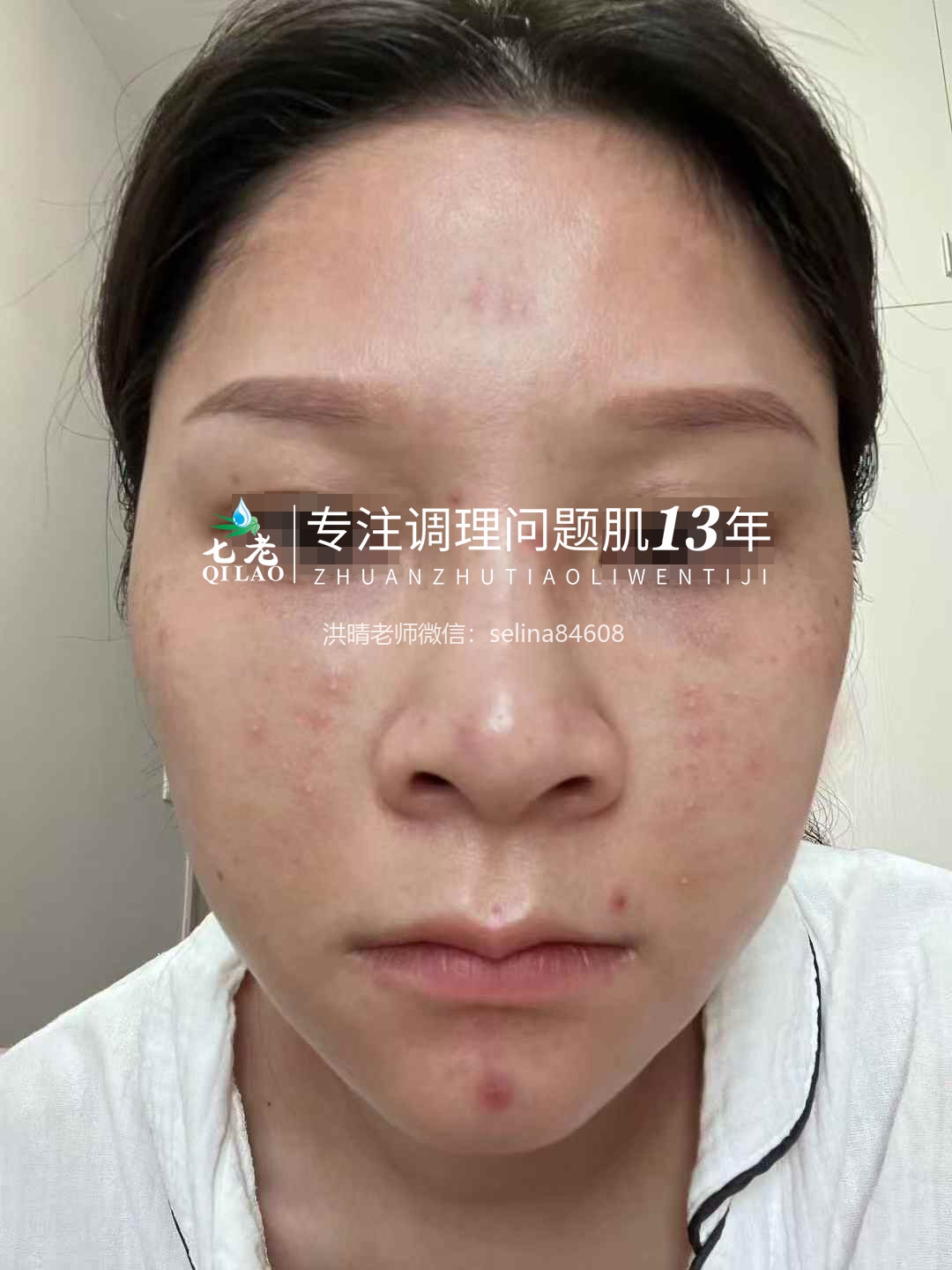 七老剥脱祛斑过敏粉刺痘痘修护案例