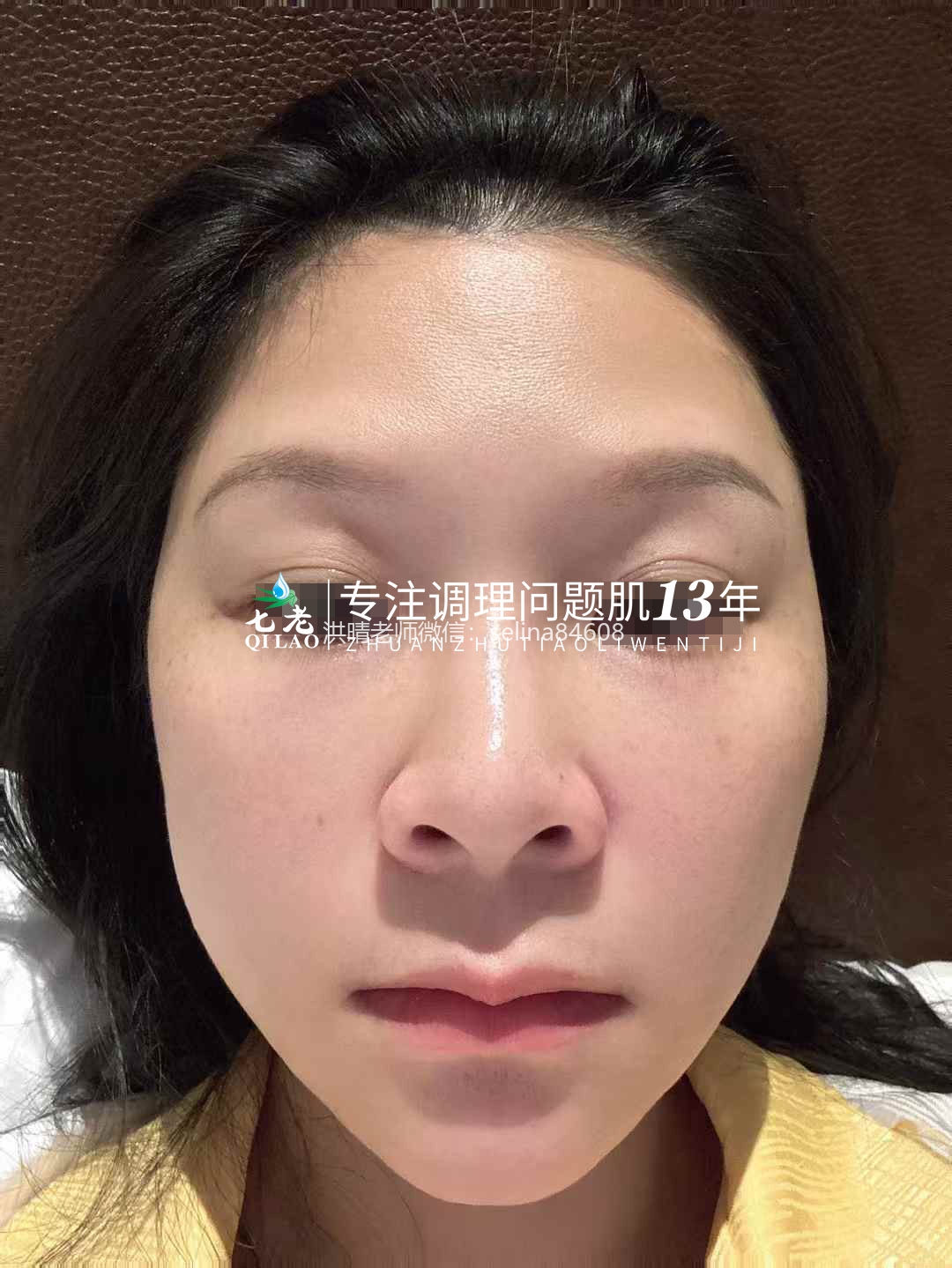 七老剥脱祛斑过敏粉刺痘痘修护案例