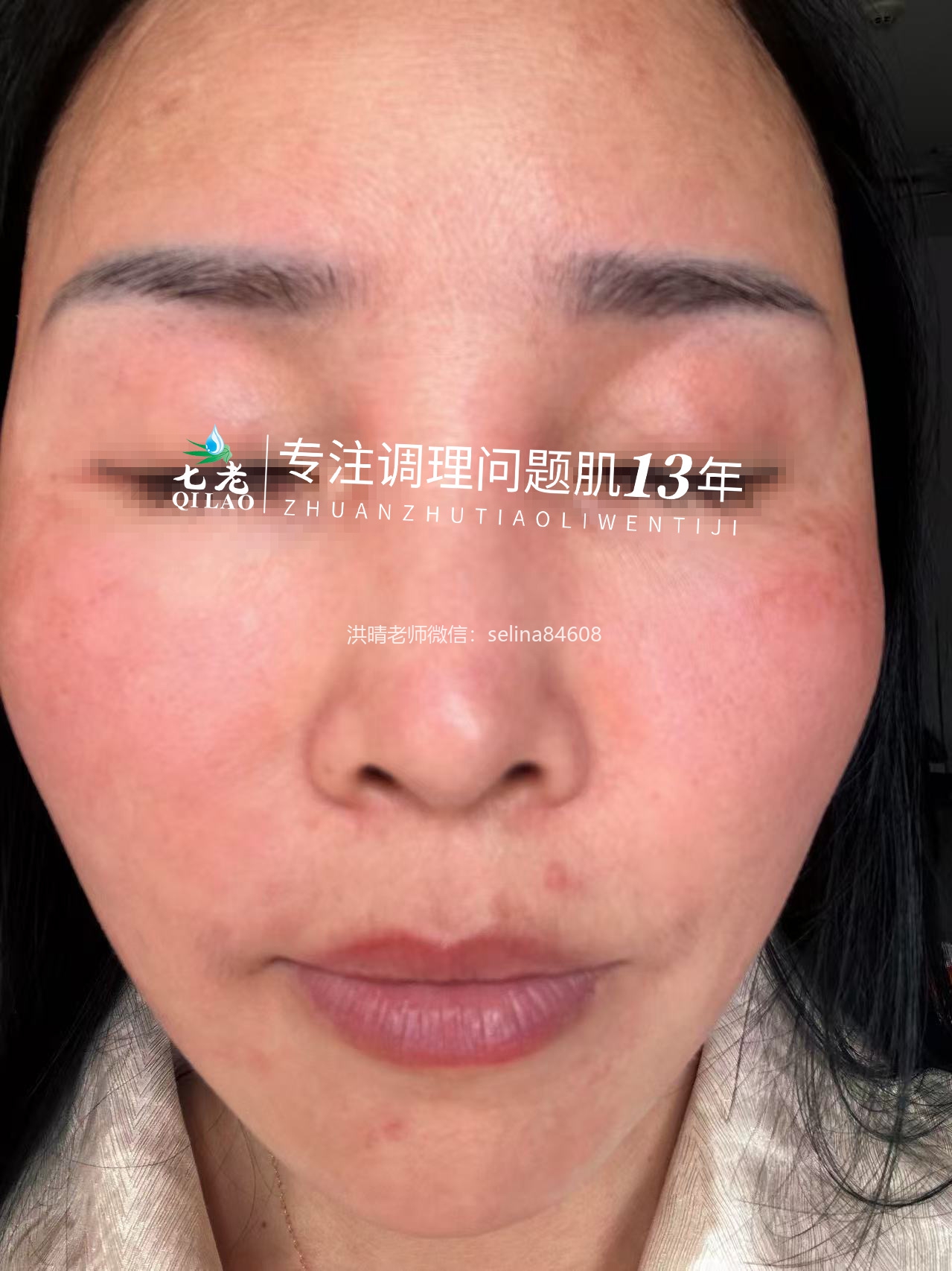 七老红肿烫痒过敏修护案例