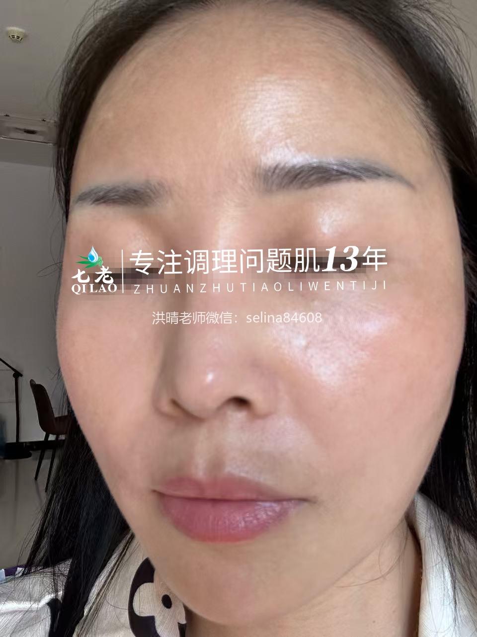 七老红肿烫痒过敏修护案例