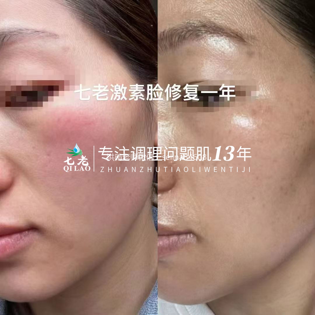 七老激素脸发红发烫修复案例