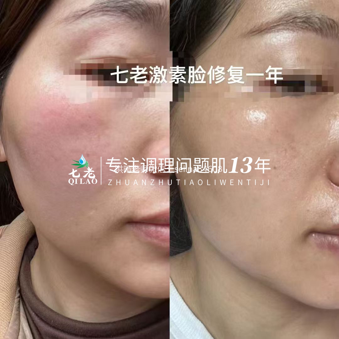 七老激素脸发红发烫修复案例