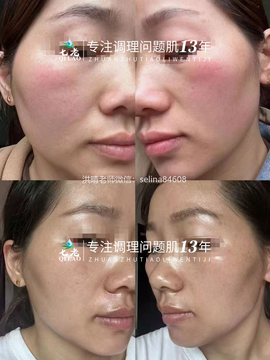 七老激素脸发红发烫修复案例