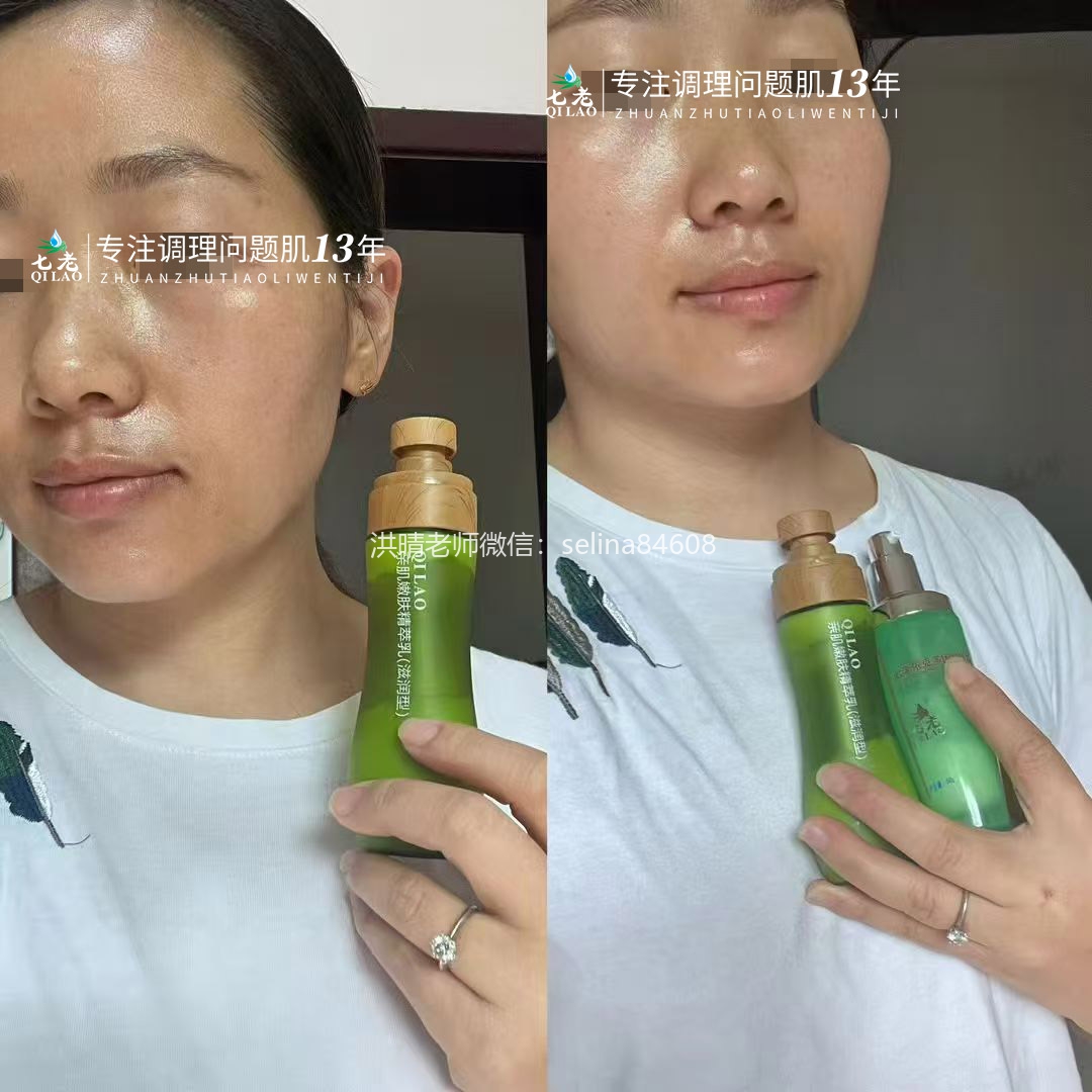 七老激素脸发红发烫修复案例