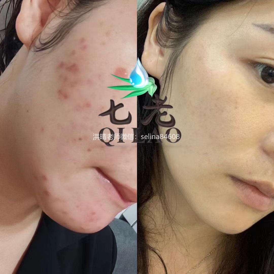 七老激素脸脂溢性皮炎修护案例