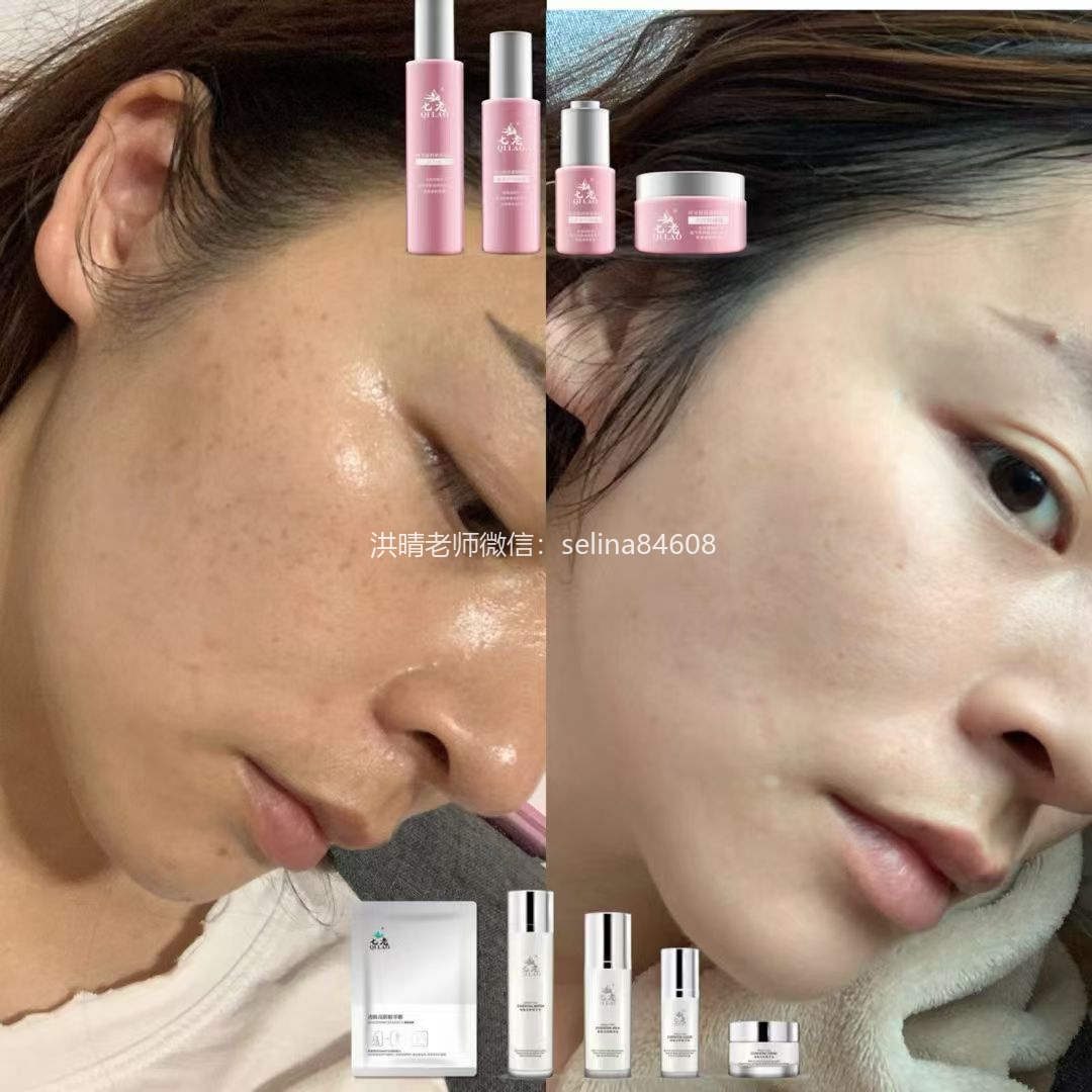 七老激素脸脂溢性皮炎修护案例