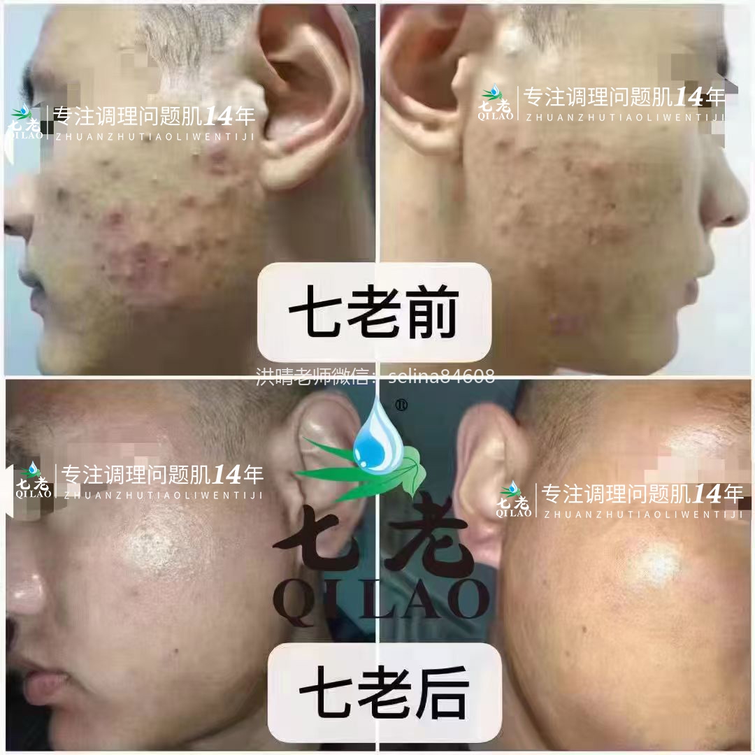 七老痘痘肌修复案例