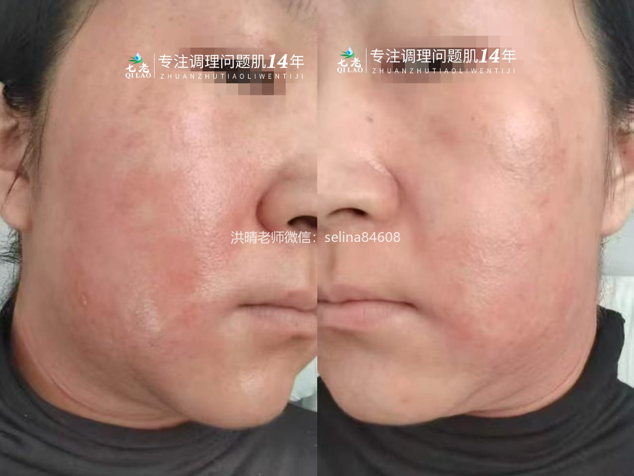 七老激素脸修复案例