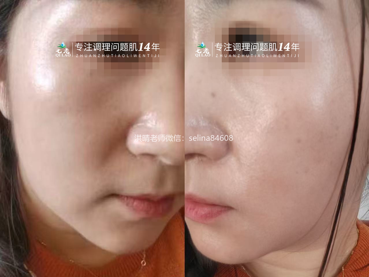 七老激素脸修复案例