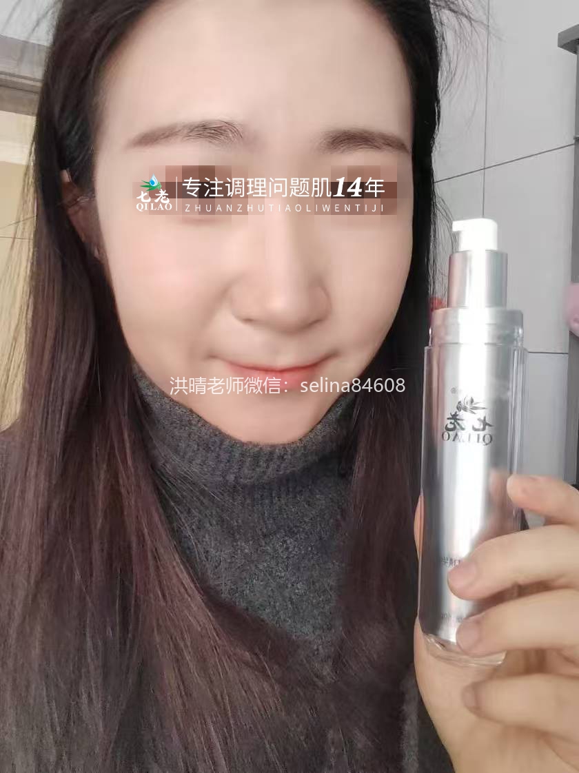 七老激素脸修复案例