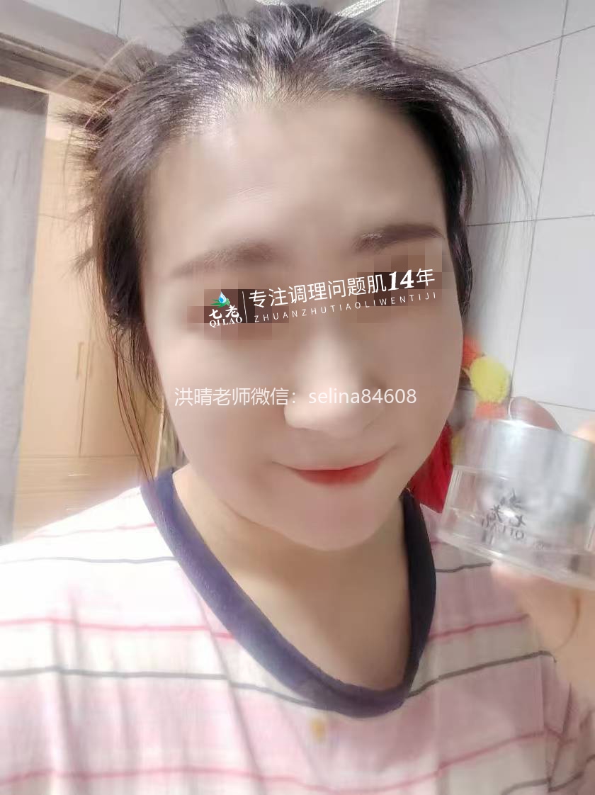 七老激素脸修复案例