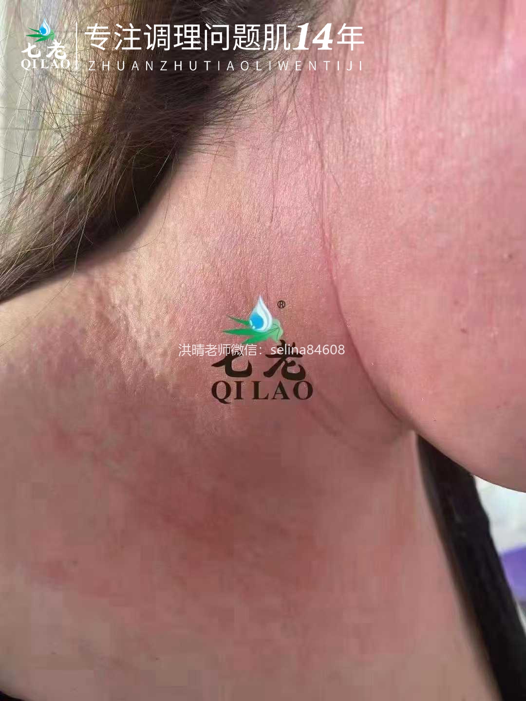 七老严重激素脸修复案例