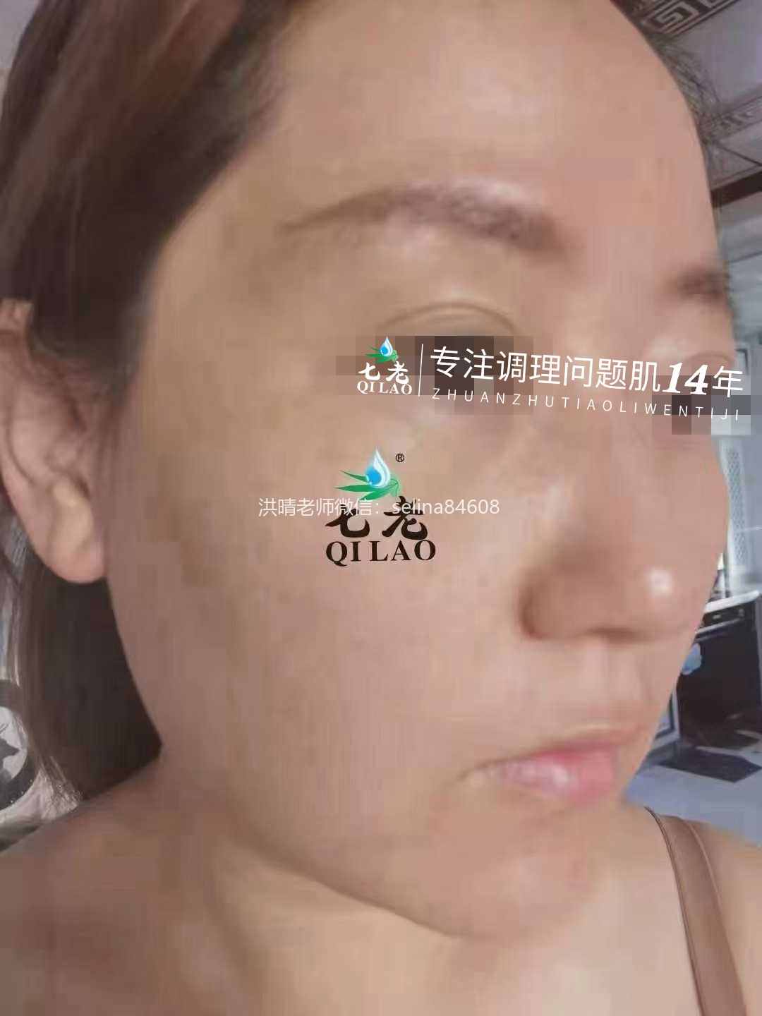 七老严重激素脸修复案例