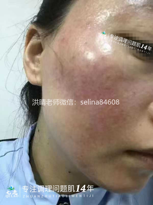 七老红烫疹子修护案例