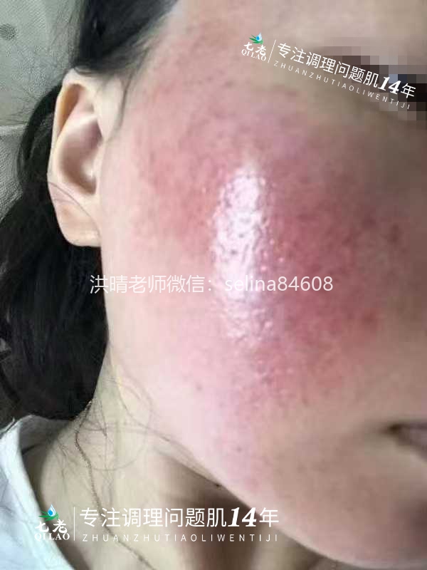 七老红烫疹子修护案例