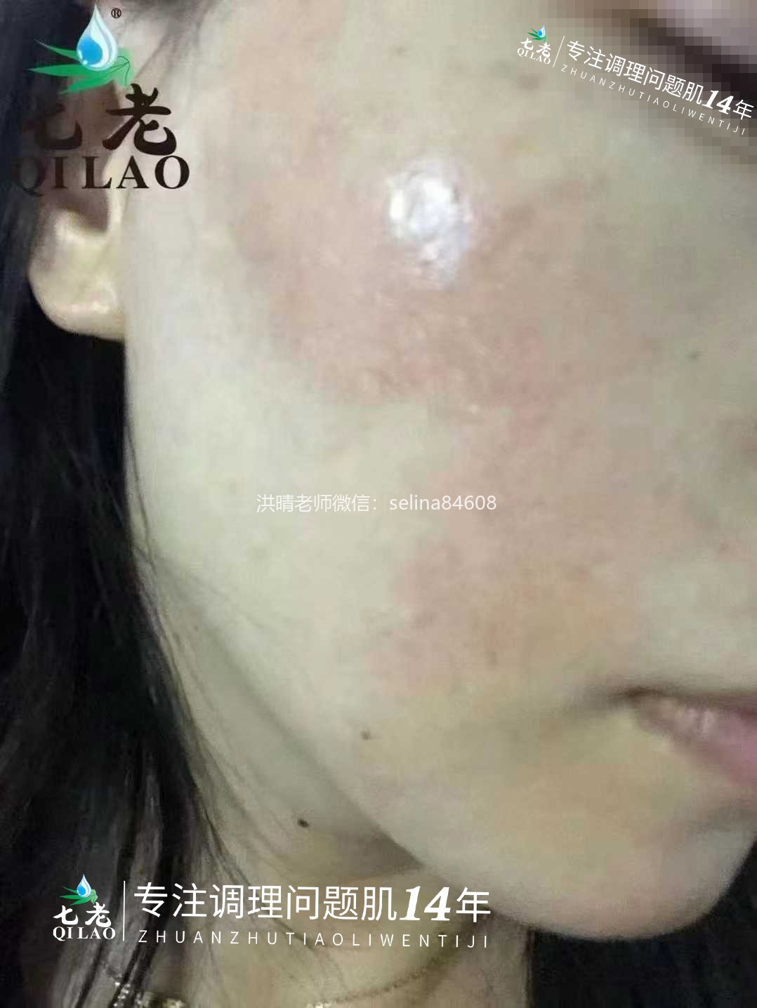 七老红烫疹子修护案例