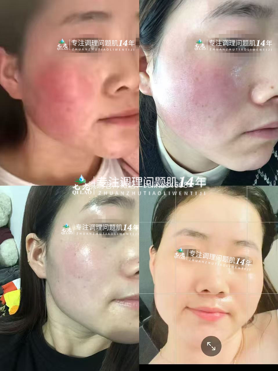 七老激素脸玫瑰修复案例