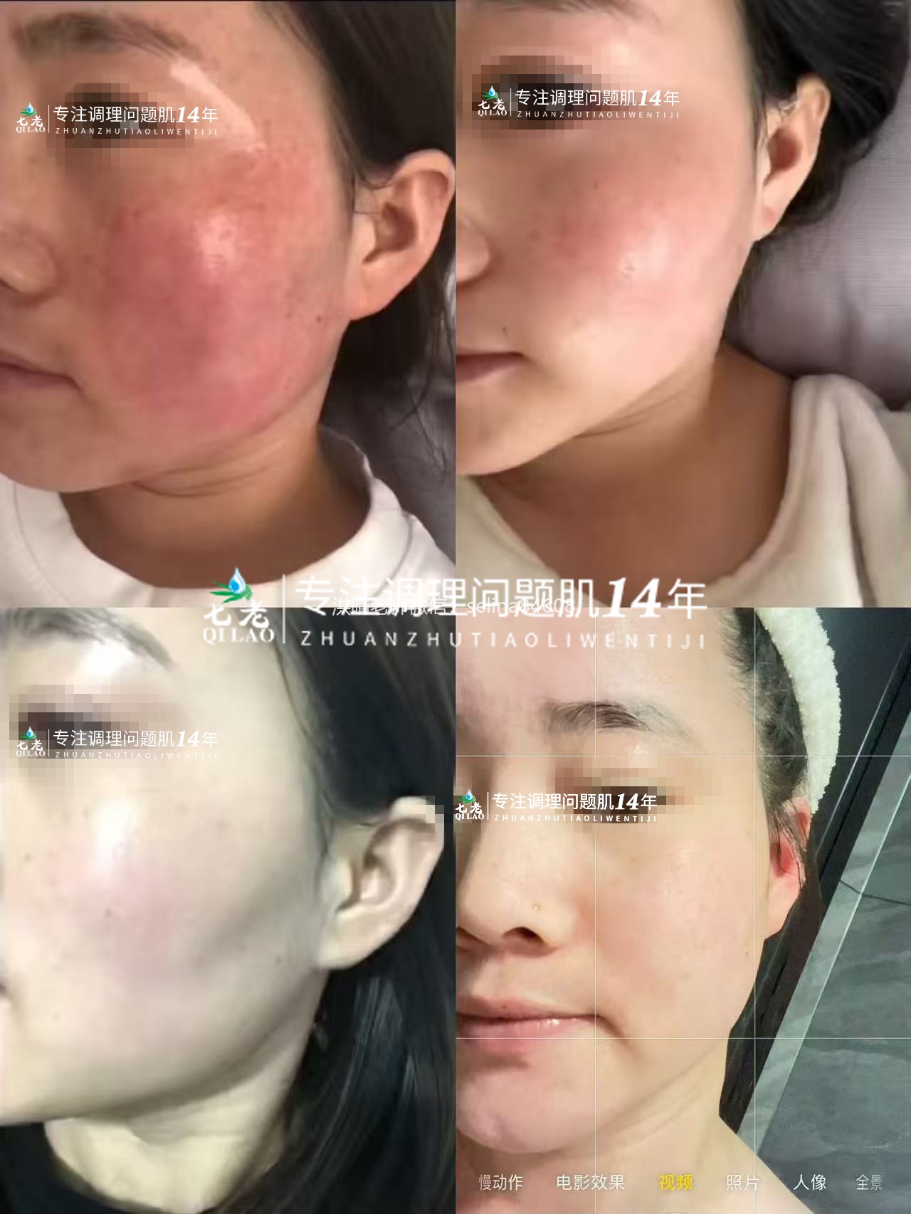 七老激素脸玫瑰修复案例