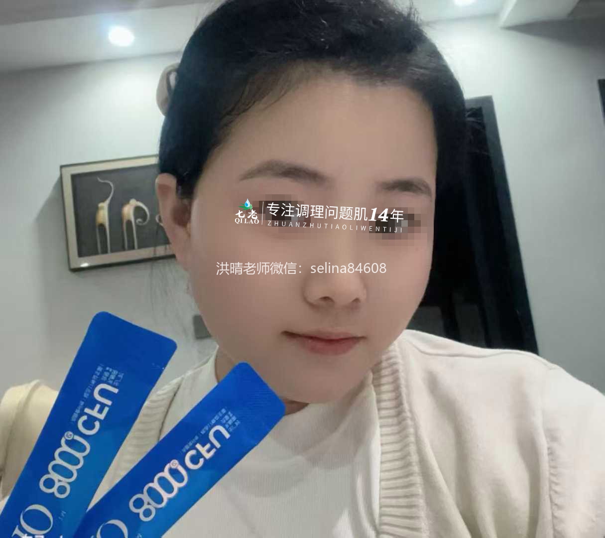 七老激素脸玫瑰修复案例